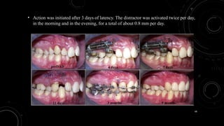 68
• Action was initiated after 3 days of latency. The distractor was activated twice per day,
in the morning and in the evening, for a total of about 0.8 mm per day.
 