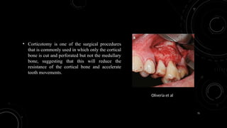 75
• Corticotomy is one of the surgical procedures
that is commonly used in which only the cortical
bone is cut and perforated but not the medullary
bone, suggesting that this will reduce the
resistance of the cortical bone and accelerate
tooth movements.
Oliveria et al
 