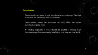 84
Decortication
• Corticotomies are done in mid interdental areas, using no. 2 carbide
bur which are connected with circular cuts.
• Corticotomies should be performed on both labial and palatal
aspects of alveolar bone.
• No mobile segments of bone should be created to initiate RAP.
Instruments used are commonly hand piece or a piezosurgical knife.
 