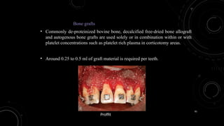 85
Bone grafts
• Commonly de-proteinized bovine bone, decalcified free-dried bone allograft
and autogenous bone grafts are used solely or in combination within or with
platelet concentrations such as platelet rich plasma in corticotomy areas.
• Around 0.25 to 0.5 ml of graft material is required per teeth.
Proffit
 