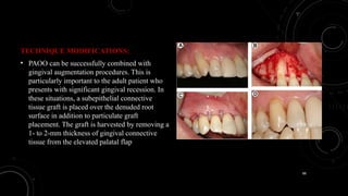 88
TECHNIQUE MODIFICATIONS:
• PAOO can be successfully combined with
gingival augmentation procedures. This is
particularly important to the adult patient who
presents with significant gingival recession. In
these situations, a subepithelial connective
tissue graft is placed over the denuded root
surface in addition to particulate graft
placement. The graft is harvested by removing a
1- to 2-mm thickness of gingival connective
tissue from the elevated palatal flap
 
