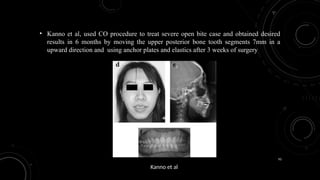 93
• Kanno et al, used CO procedure to treat severe open bite case and obtained desired
results in 6 months by moving the upper posterior bone tooth segments 7mm in a
upward direction and using anchor plates and elastics after 3 weeks of surgery
Kanno et al
 