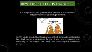 94
HOW DOES CORTICOTOMY WORK ?
Local injury to the alveolar process reduces resistance to tooth movement
and generates rapid acceleratory phenomenon.
In 2001 wilcko reported that the acceleration of tooth movement is not due to the
bony block movement as postulated by kole ; it was rather a process of bone
remodeling at the surgical site, which was called regional acceleratory
phenomenon.
 