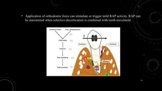 97
• Application of orthodontic force can stimulate or trigger mild RAP activity. RAP can
be maximized when selective decortication is combined with tooth movement.
 
