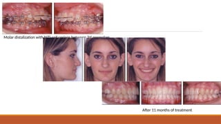 ACCELERATED ORTHODONTICS by dr ashwani singh.pptx