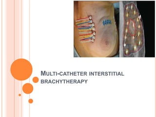 MULTI-CATHETER INTERSTITIAL
BRACHYTHERAPY
 