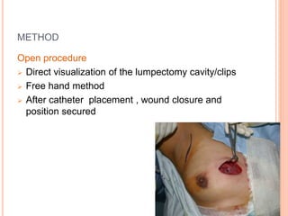 METHOD
Open procedure
 Direct visualization of the lumpectomy cavity/clips
 Free hand method
 After catheter placement , wound closure and
position secured
 