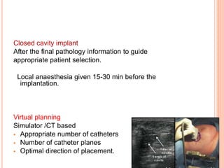 Closed cavity implant
After the final pathology information to guide
appropriate patient selection.
Local anaesthesia given 15-30 min before the
implantation.
Virtual planning
Simulator /CT based
 Appropriate number of catheters
 Number of catheter planes
 Optimal direction of placement.
 