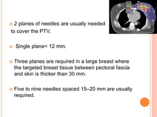  2 planes of needles are usually needed
to cover the PTV.
 Single plane< 12 mm.
 Three planes are required in a large breast where
the targeted breast tissue between pectoral fascia
and skin is thicker than 30 mm.
 Five to nine needles spaced 15–20 mm are usually
required.
 