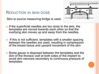 REDUCTION IN SKIN DOSE
Skin to source measuring bridge is used.
 If the superficial needles are too close to the skin, the
templates are moved towards each other so that the
overlying skin moves up and away from the needles.
 If this is not sufficient, templates with a smaller spacing
between the needles are used, resulting in compression
of the breast tissue and upward movement of the skin
 Some gauze is disposed between the templates and the
skin of the thoracic wall at both sides of the implant to
avoid skin necrosis secondary to continuous pressure of
templates.
 