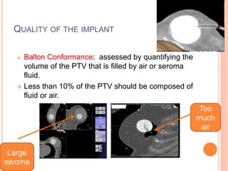QUALITY OF THE IMPLANT
 Ballon Conformance: assessed by quantifying the
volume of the PTV that is filled by air or seroma
fluid.
 Less than 10% of the PTV should be composed of
fluid or air.
Too
much
air
Large
seroma
 