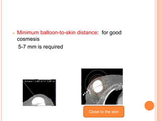  Minimum balloon-to-skin distance: for good
cosmesis
5-7 mm is required
Close to the skin
 