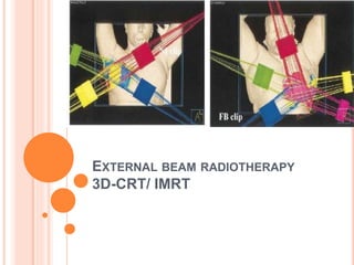 EXTERNAL BEAM RADIOTHERAPY
3D-CRT/ IMRT
 