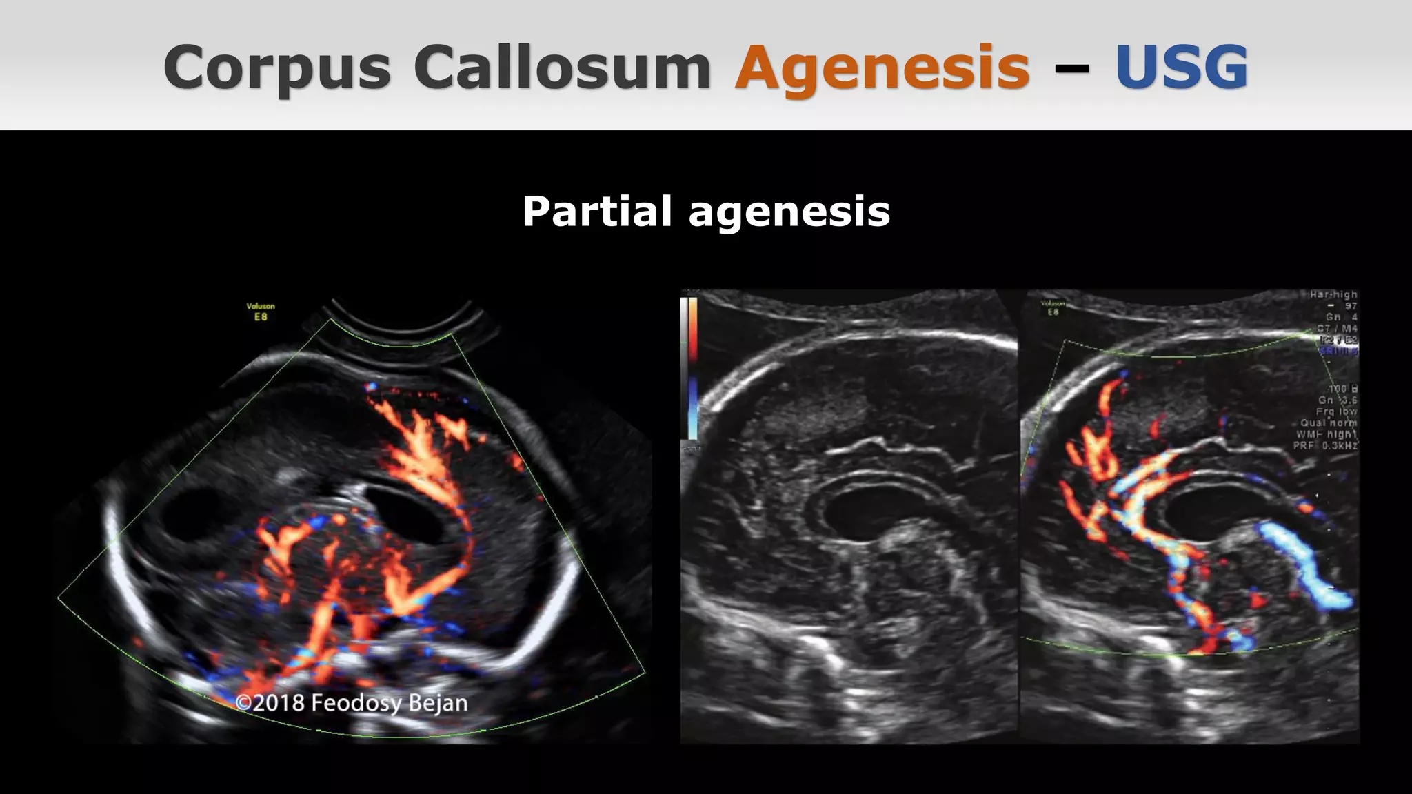 Agenesis of the Corpus Callosum | PDF