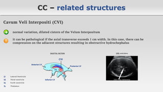 Agenesis of the Corpus Callosum | PDF