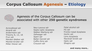 Agenesis of the Corpus Callosum | PDF