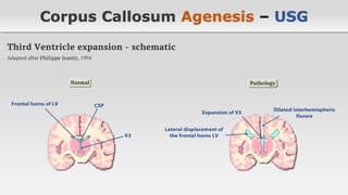 Agenesis of the Corpus Callosum | PDF