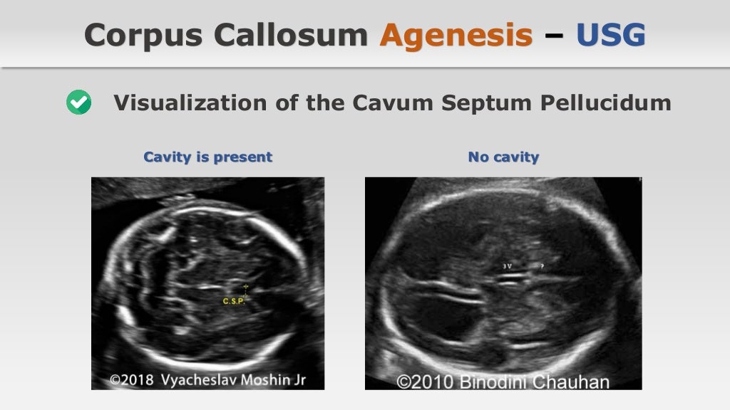 Agenesis of the Corpus Callosum