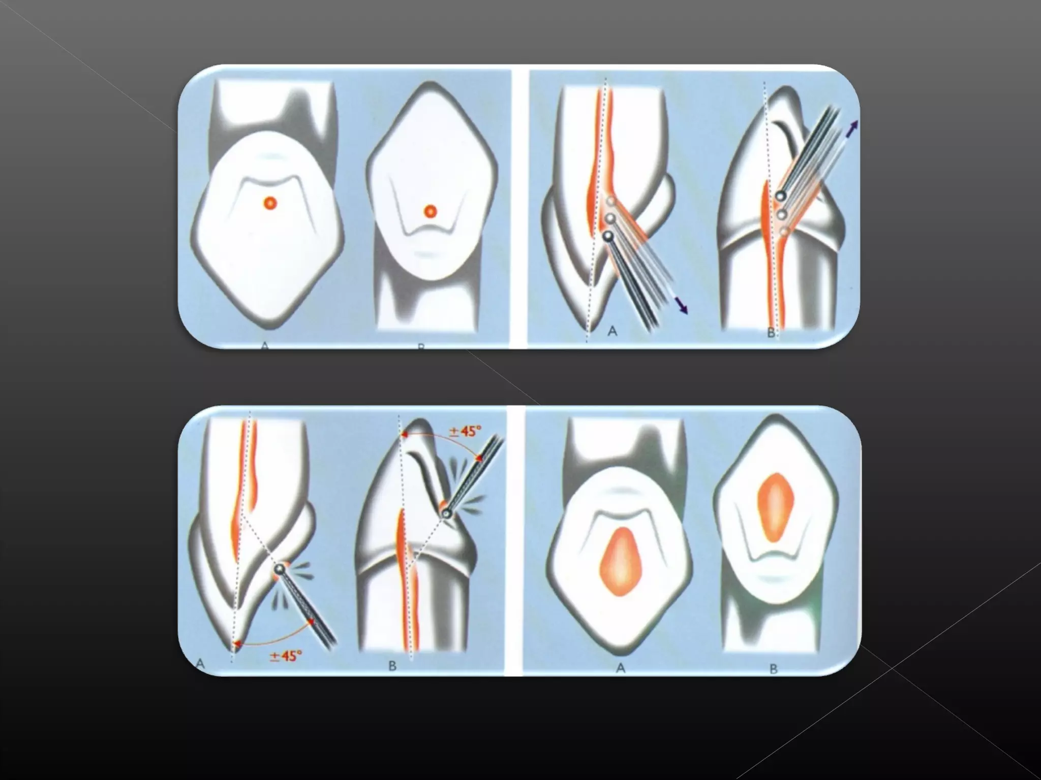 Acceso a la cavidad 2