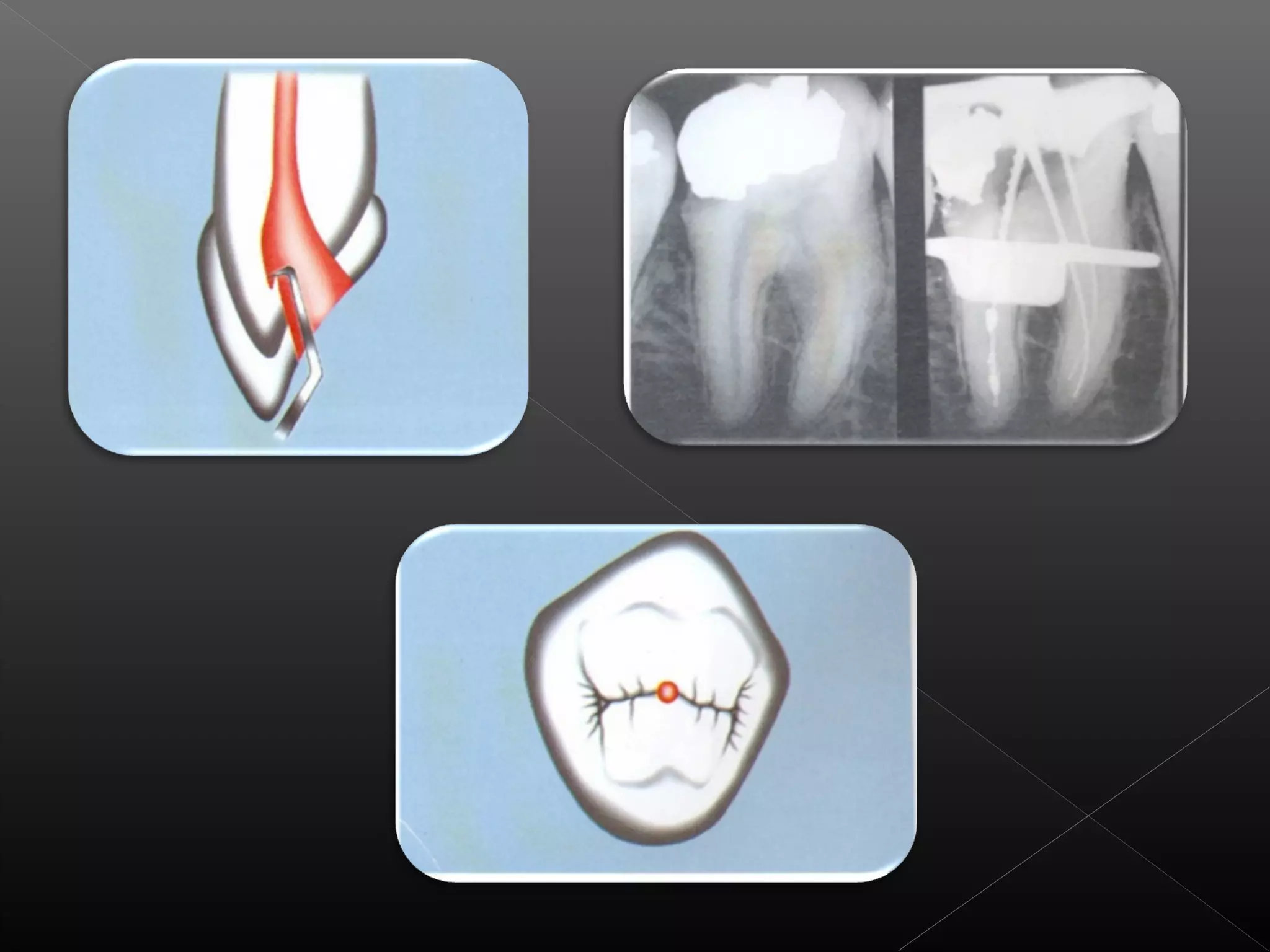 Acceso a la cavidad 2