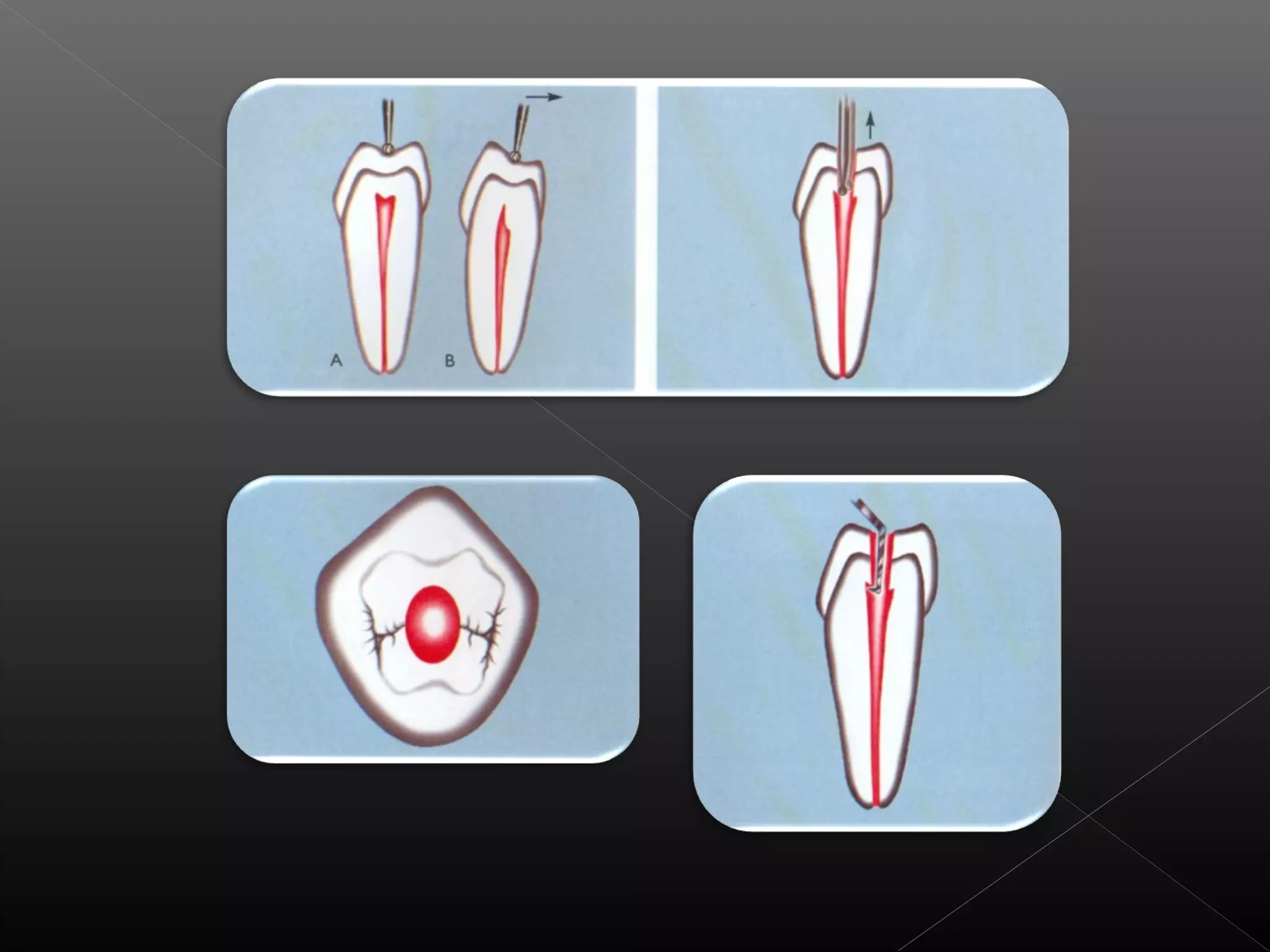 Acceso a la cavidad 2