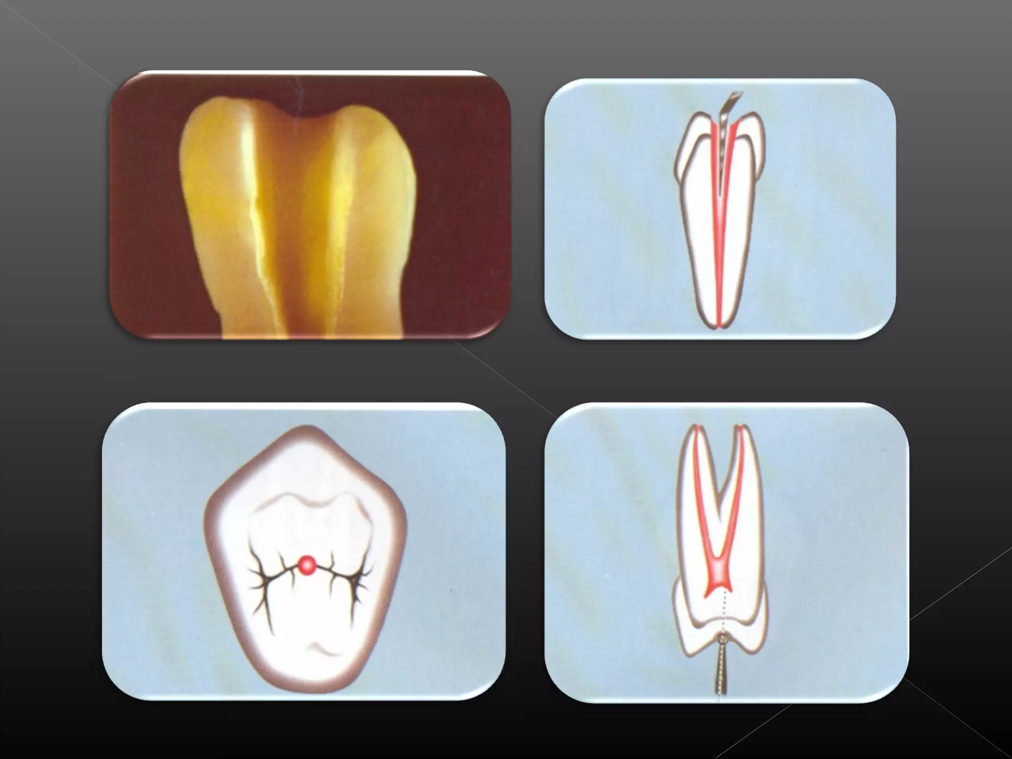 Acceso a la cavidad 2