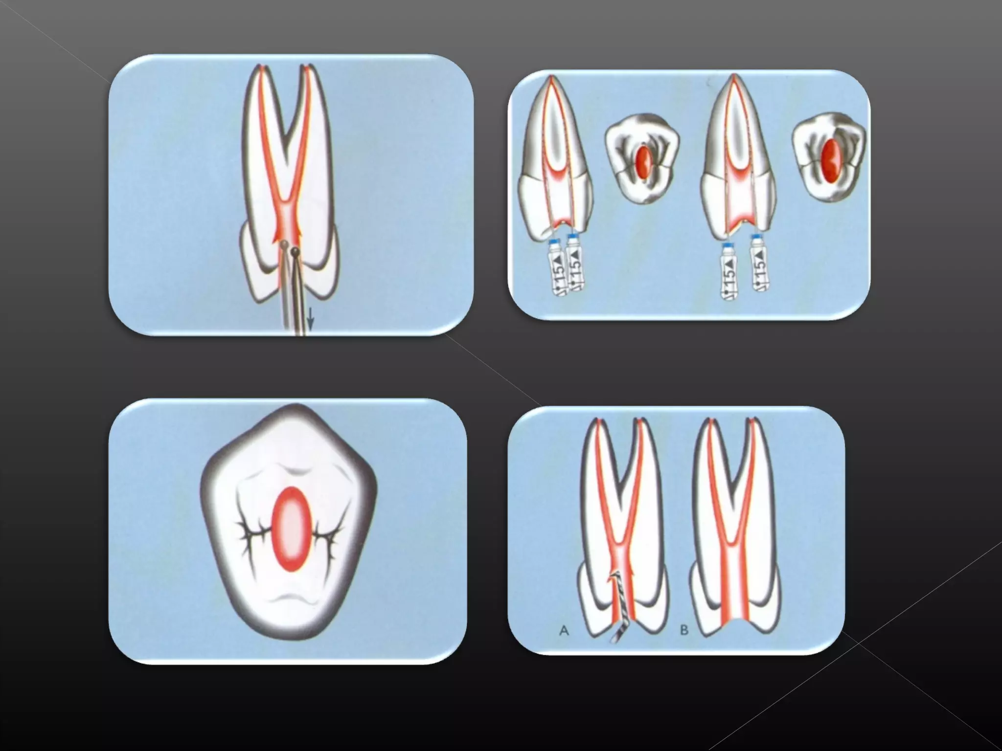 Acceso a la cavidad 2