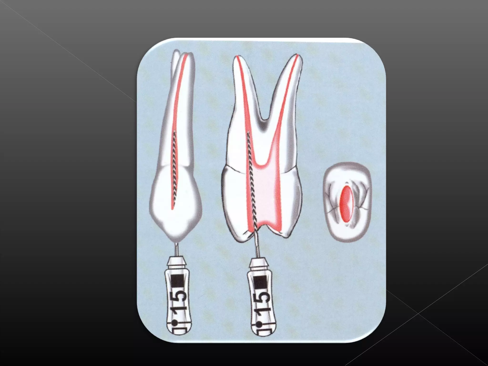 Acceso a la cavidad 2