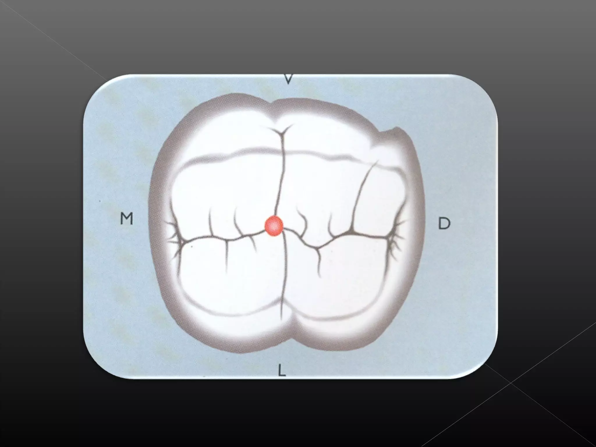 Acceso a la cavidad 2