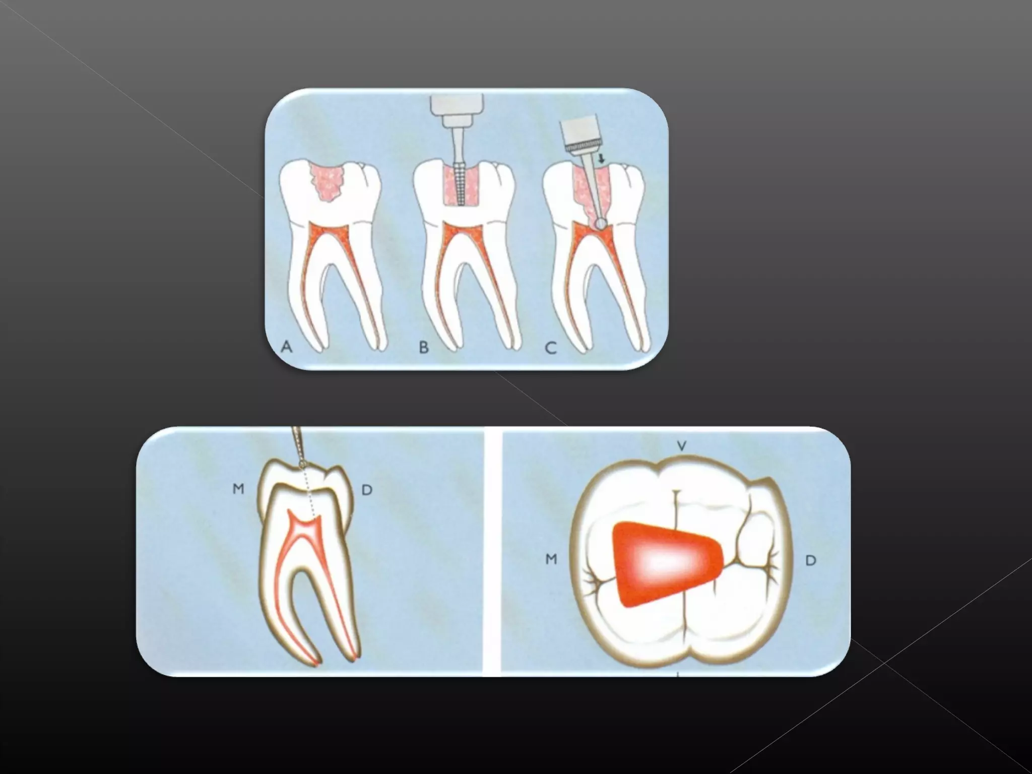 Acceso a la cavidad 2