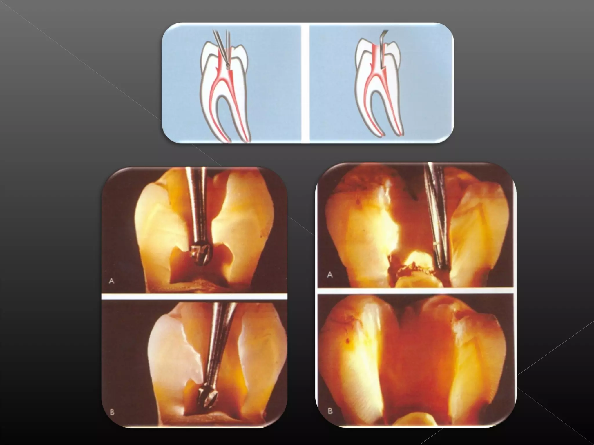 Acceso a la cavidad 2