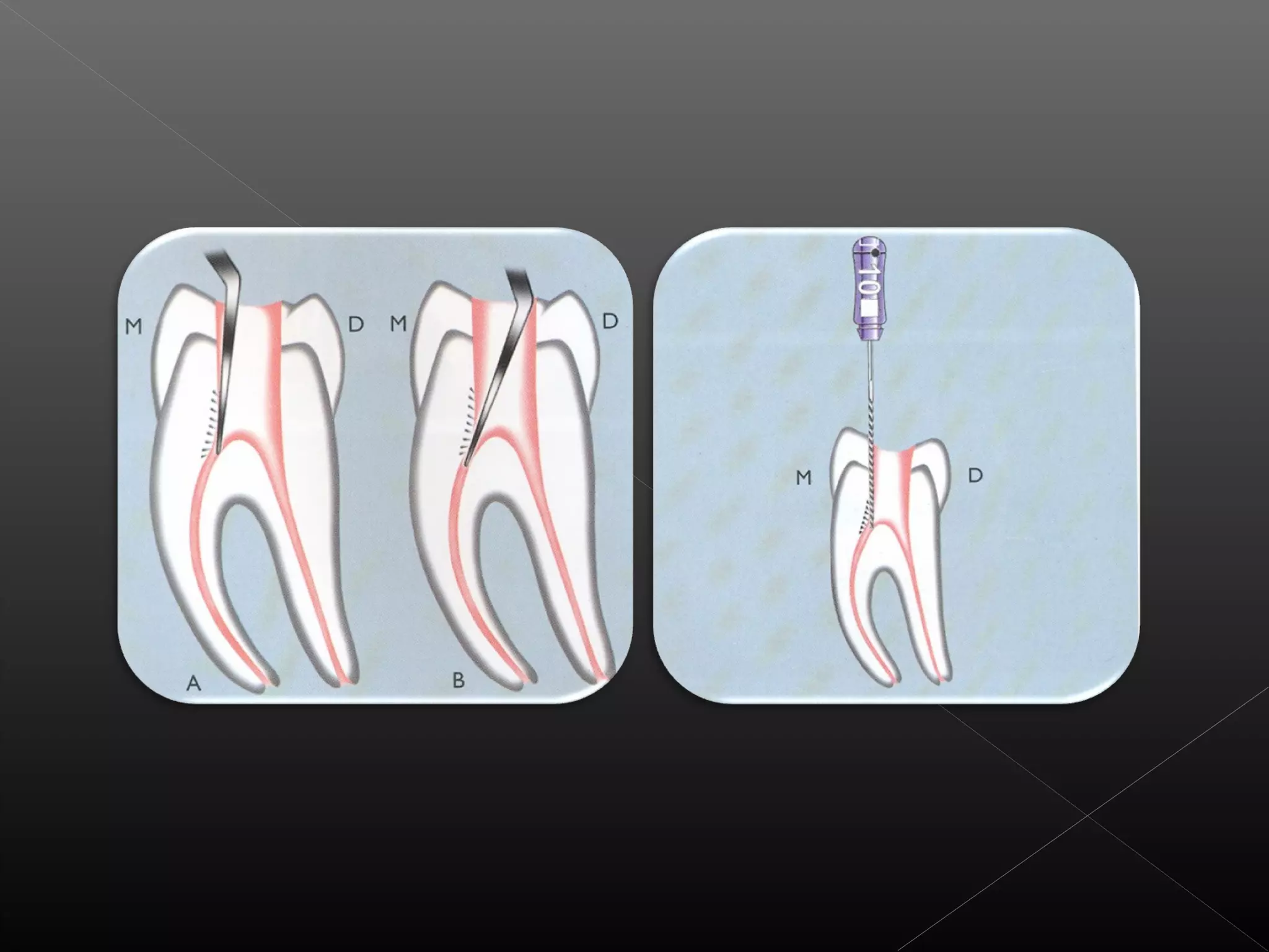 Acceso a la cavidad 2