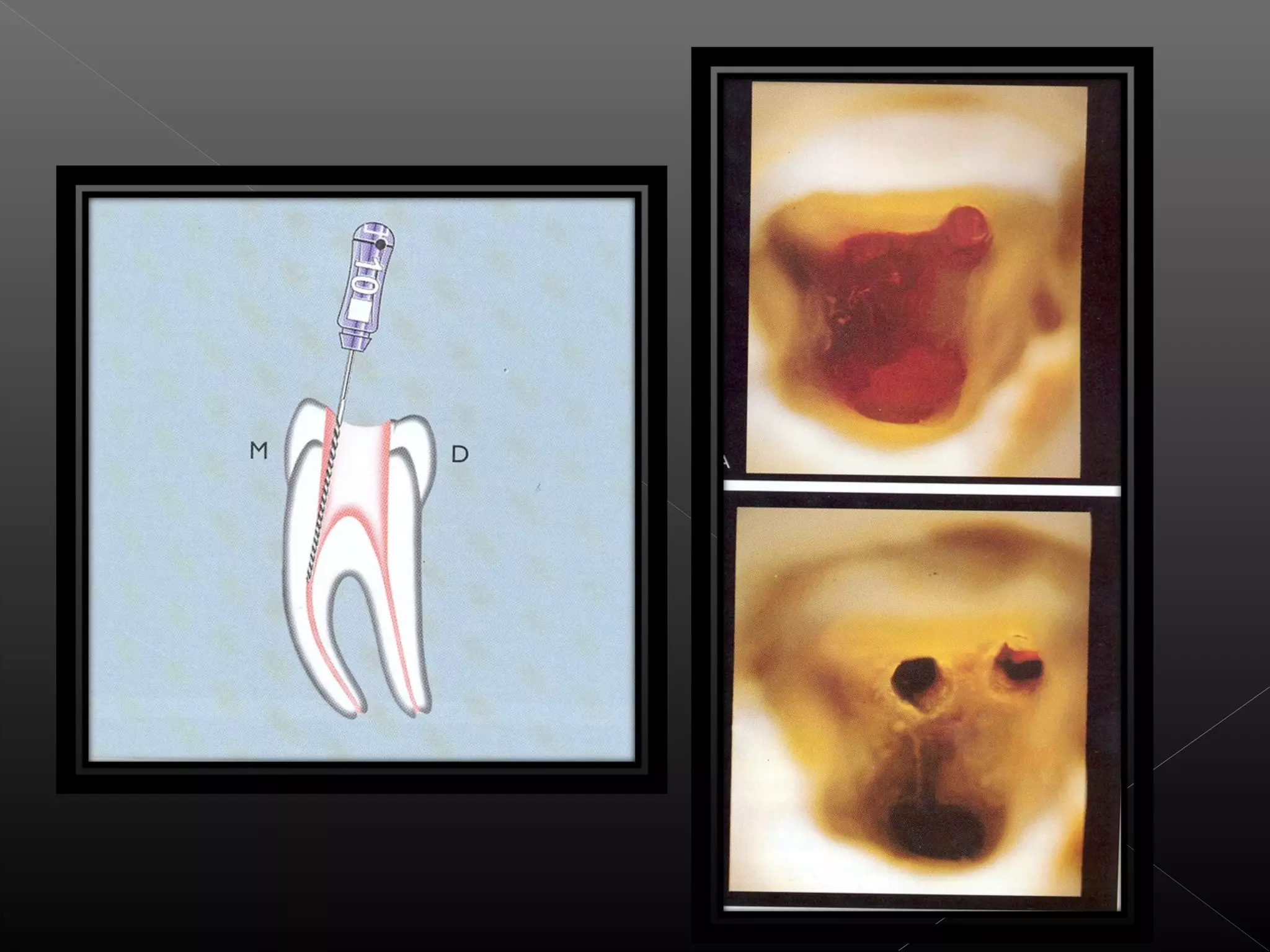 Acceso a la cavidad 2