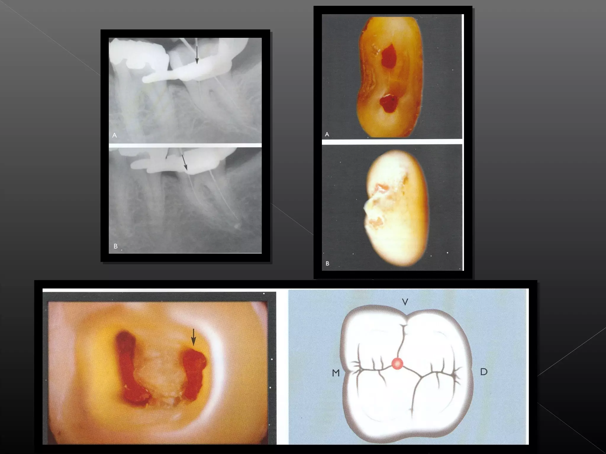 Acceso a la cavidad 2