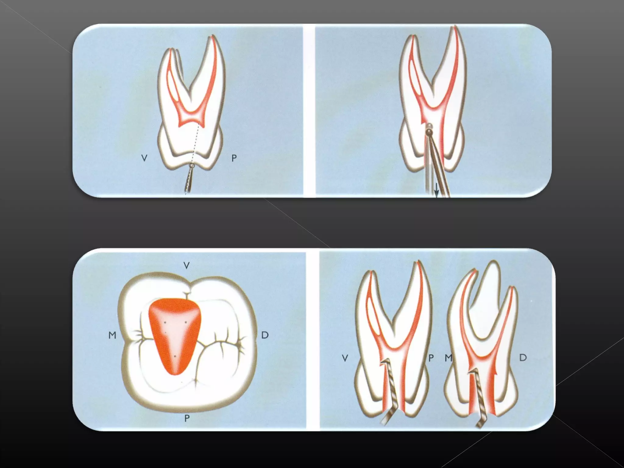 Acceso a la cavidad 2