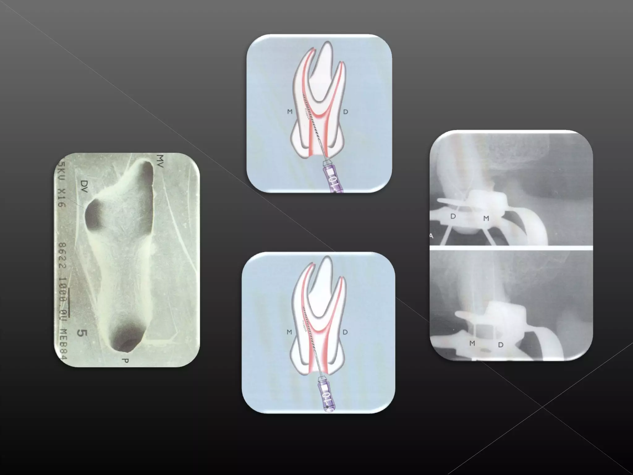 Acceso a la cavidad 2