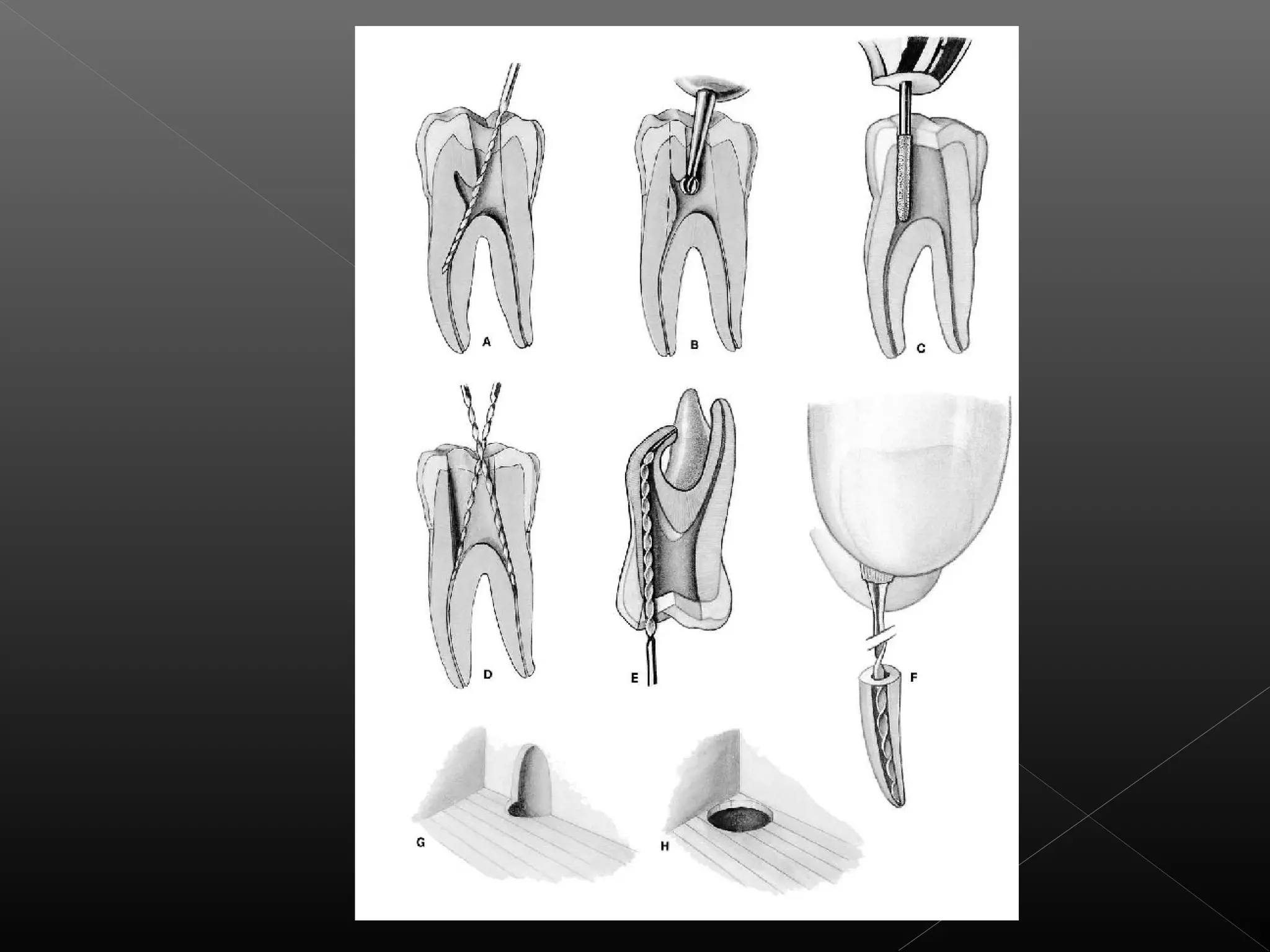 Acceso a la cavidad 2