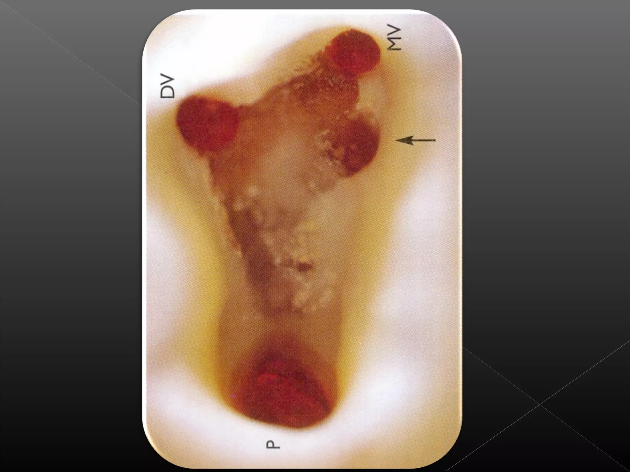 Acceso a la cavidad 2