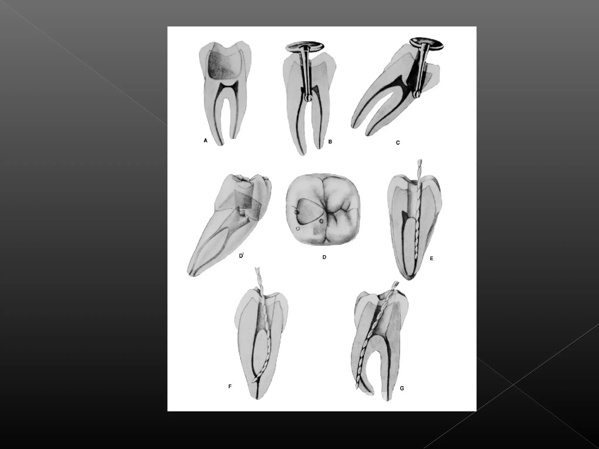 Acceso a la cavidad 2
