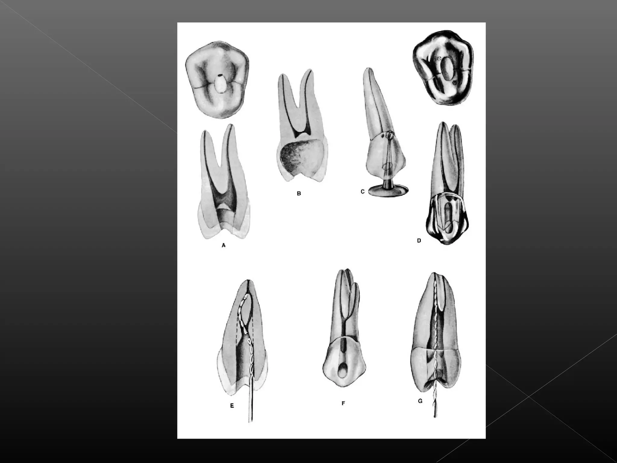 Acceso a la cavidad 2