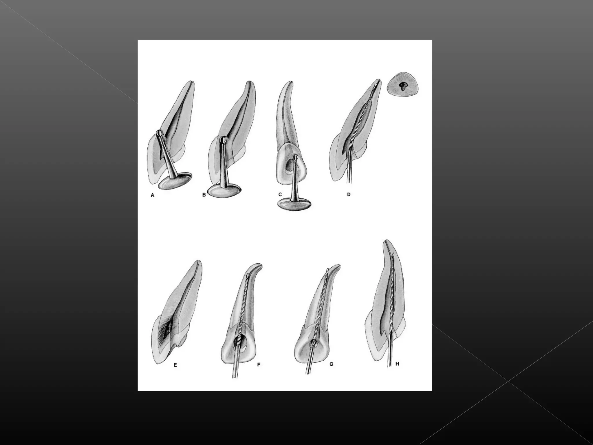 Acceso a la cavidad 2