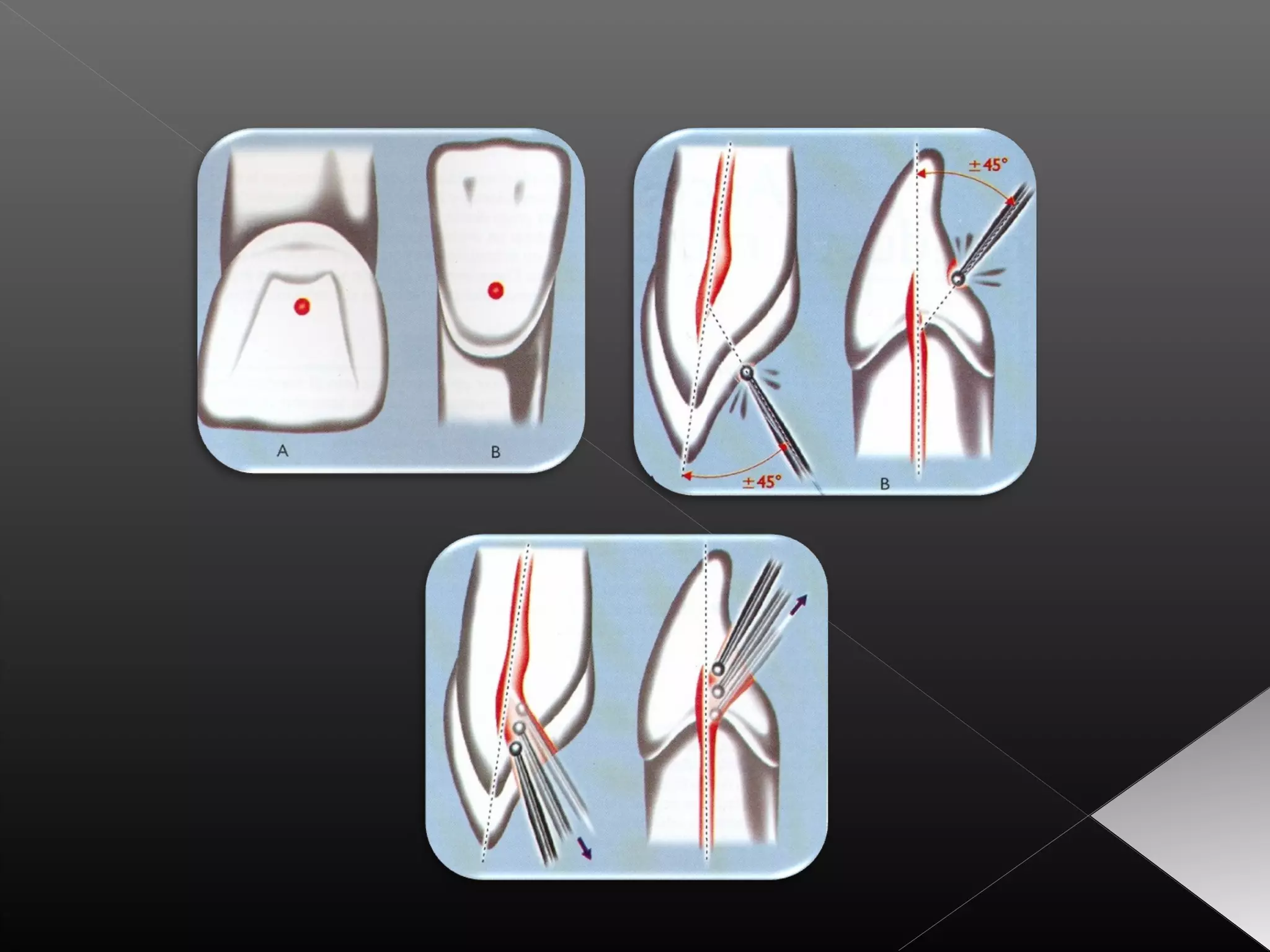 Acceso a la cavidad 2