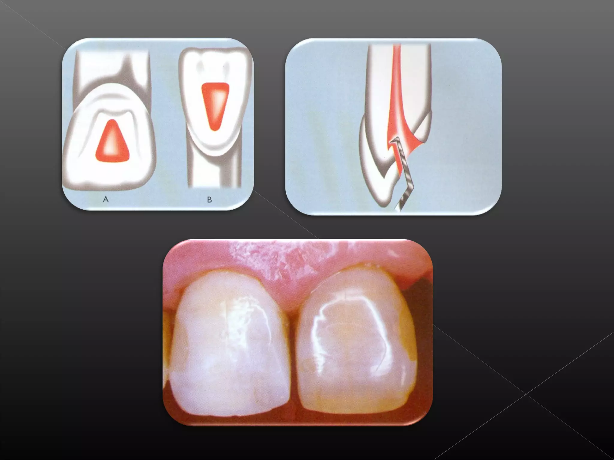 Acceso a la cavidad 2