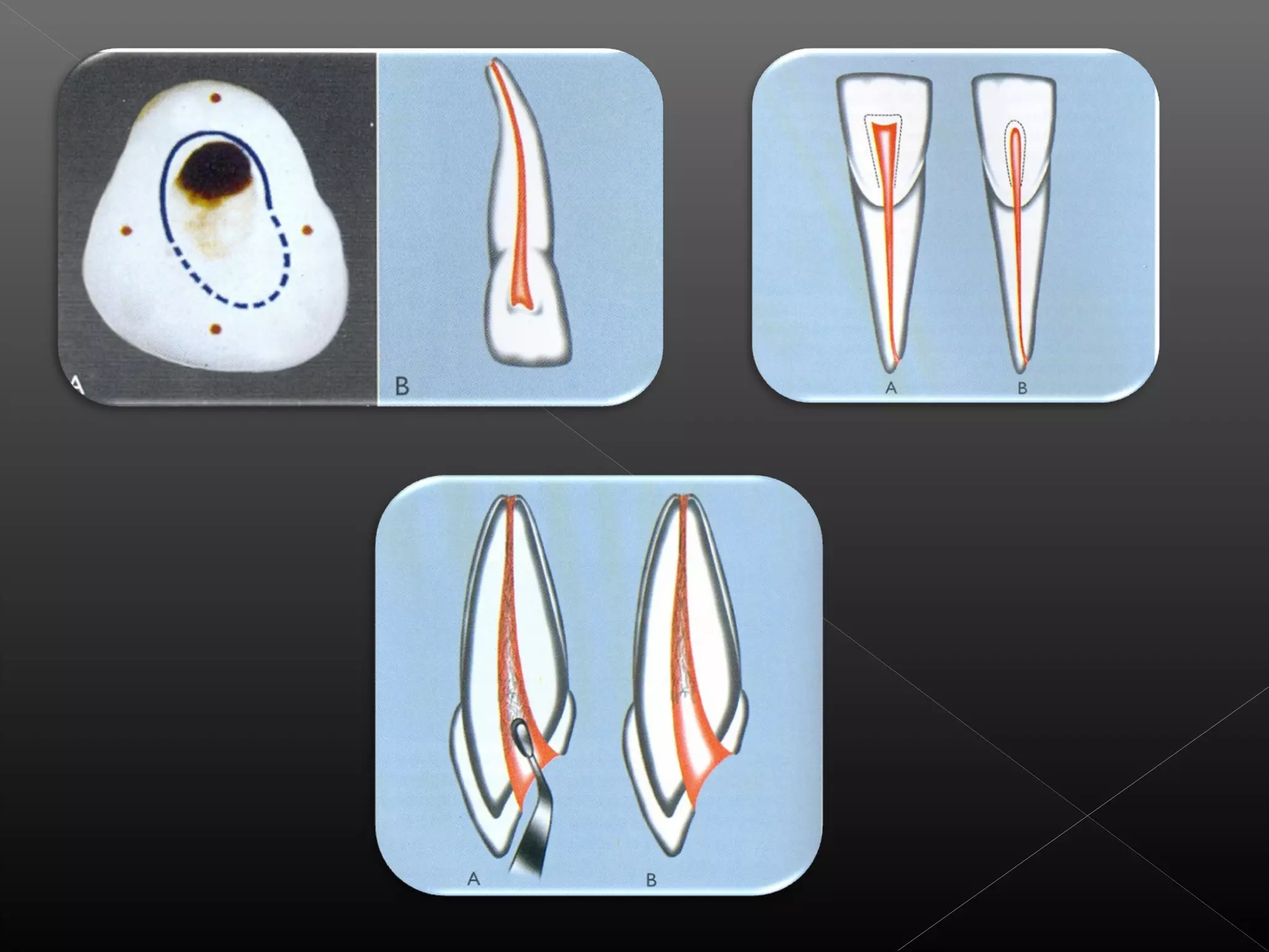 Acceso a la cavidad 2