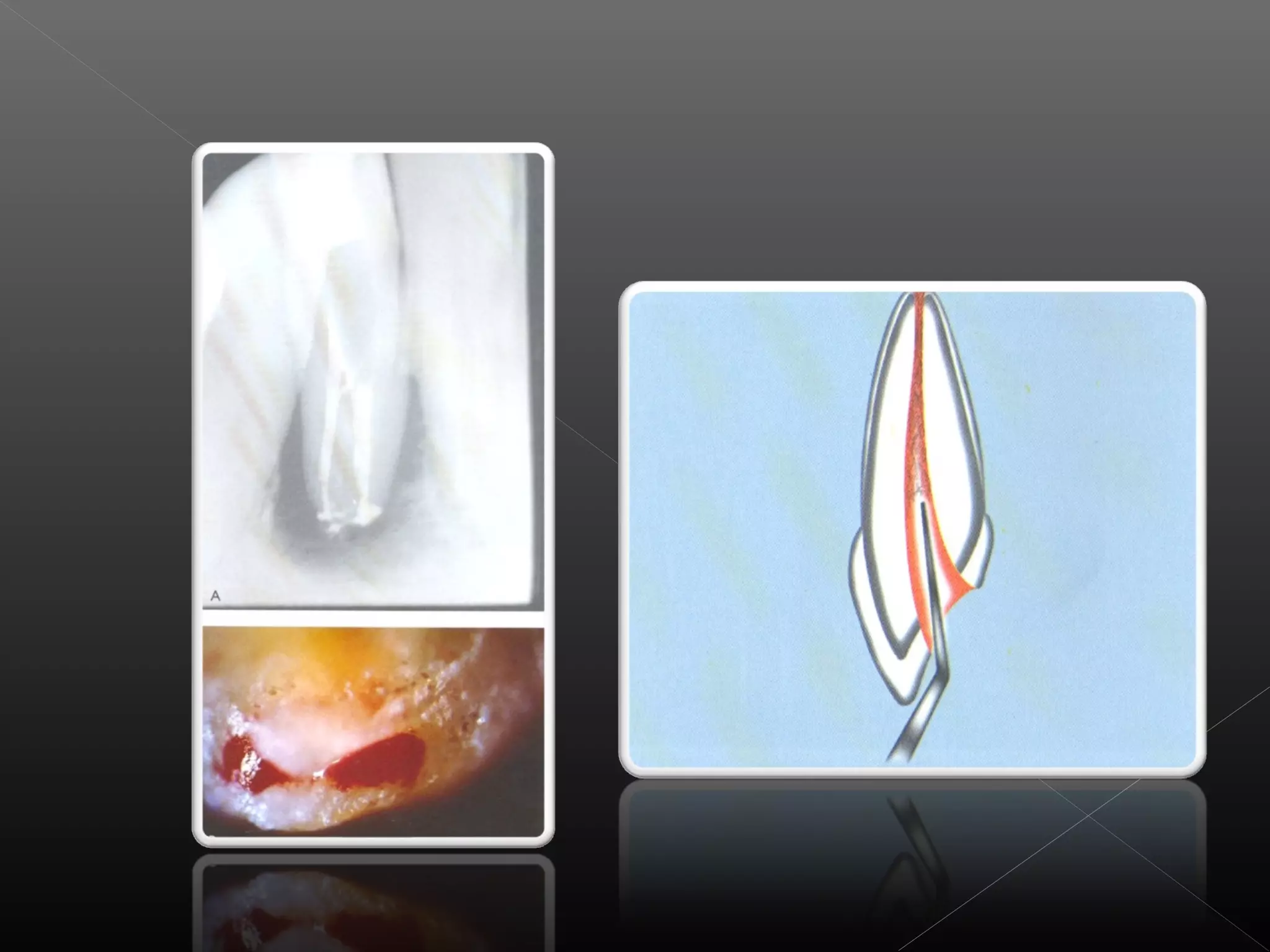 Acceso a la cavidad 2