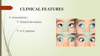CLINICAL FEATURES
6. Associations :
 Vertical deviations
 A-V patterns
 
