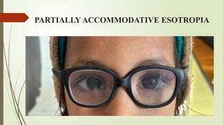 PARTIALLY ACCOMMODATIVE ESOTROPIA
Esotropia caused by combination of hypermetropia and high AC/A
ratio
 