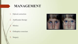 MANAGEMENT
1. Optical correction
2. Amblyopia therapy
3. Miotics
4. Orthoptics exercises
5. Surgery
 