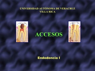 UNIVERSIDAD AUTÓNOMA DE VERACRUZ
            VILLA RICA




        ACCESOS


          Endodoncia I
 