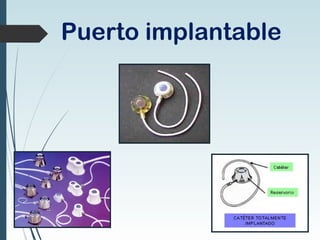 Puerto implantable
 